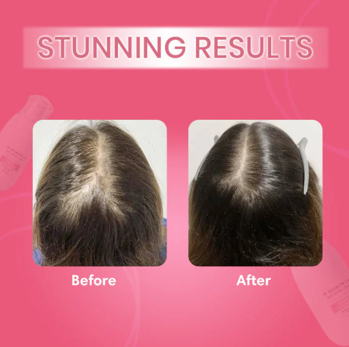 Hair–Regrowth Spray 2.0